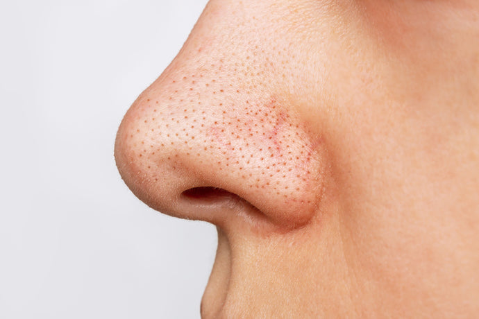 All you need to know about Blackheads